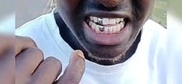 silver and gold tooth caps 0792857761